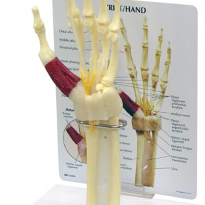 Hand/Pols met Carpaaltunnel syndroom