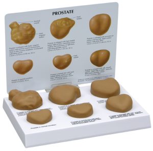 Prostaat Model met Ziektes