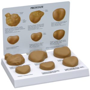 Prostaat Model met Ziektes