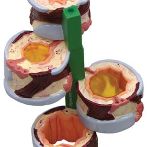 Luchtpijp (Bronchus), 4-dlg model met ziektebeelden