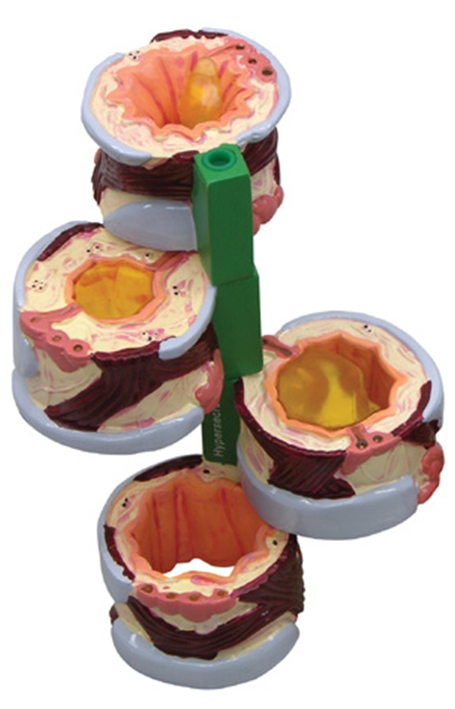 Luchtpijp (Bronchus), 4-dlg model met ziektebeelden