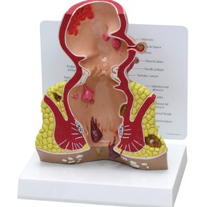 Endeldarm (Rectum), model met infokaart