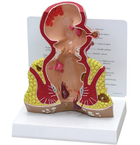 Endeldarm (Rectum), model met infokaart