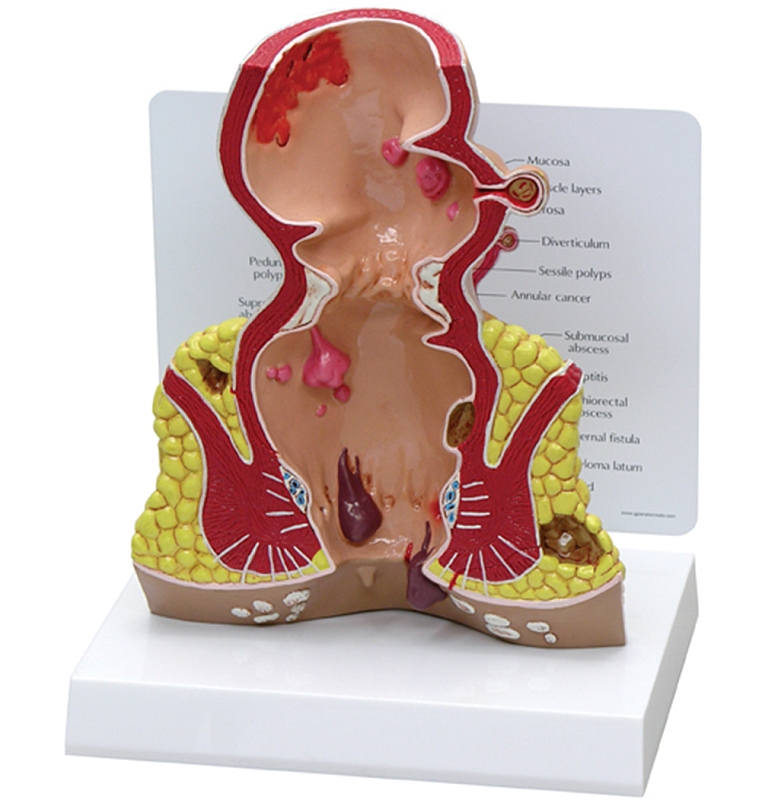Endeldarm (Rectum), model met infokaart