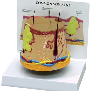 Huid acné model + infokaart