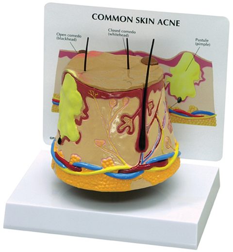 Huid acné model + infokaart