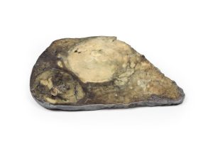 Hepatocellulair Carcinoom, 3D Print