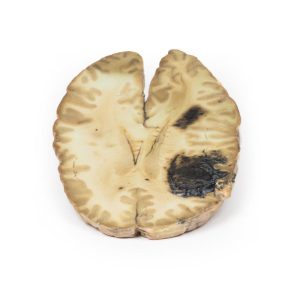 Hersenbloeding, secundair aan AML, 3D Print