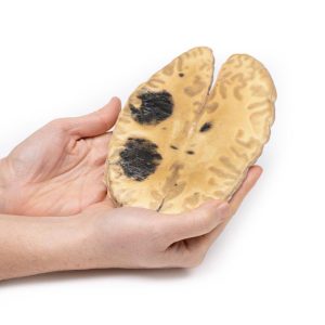 Hersenbloeding, secundair aan AML, 3D Print