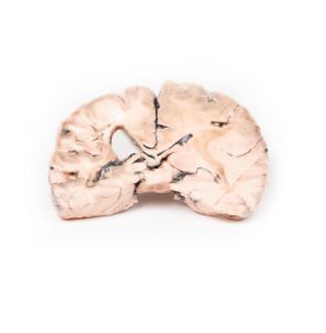 Herseninfarct Links, 3D Print