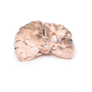 Herseninfarct Links, 3D Print
