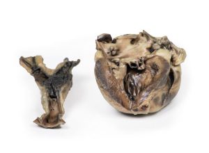 Hydatide Cysten, die het hart en de aorta aantasten, 3D Print