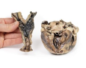 Hydatide Cysten, die het hart en de aorta aantasten, 3D Print