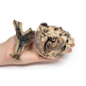 Hydatide Cysten, die het hart en de aorta aantasten, 3D Print