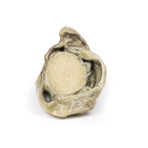 Hydrocele, 3D Print