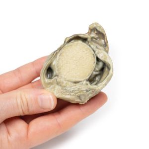 Hydrocele, 3D Print