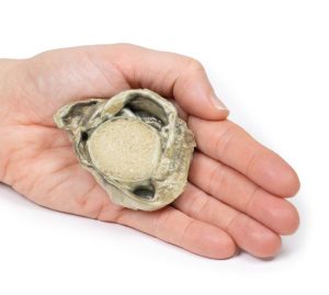 Hydrocele, 3D Print