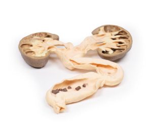 Hydronefrose en Hydro-ureter, 3D Print