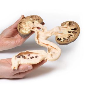 Hydronefrose en Hydro-ureter, 3D Print