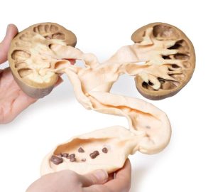Hydronefrose en Hydro-ureter, 3D Print