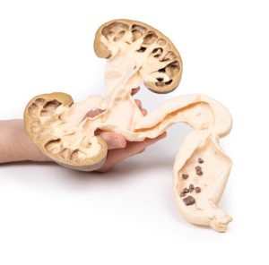 Hydronefrose en Hydro-ureter, 3D Print