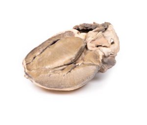 Hypertrofische Subaortastenose, 3D Print