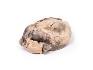 Hypertrofische Subaortastenose, 3D Print