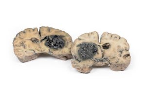 Intracerebrale Bloeding, 3D Print