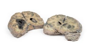Intracerebrale Bloeding, 3D Print
