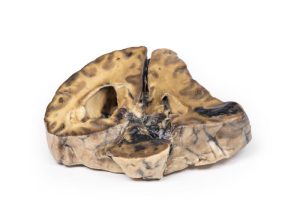 Intracraniële Ruimte Innemende Laesie, 3D Print