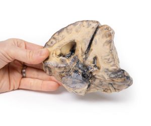 Intracraniële Ruimte Innemende Laesie, 3D Print