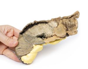 Intussusceptie van Dunne Darm, 3D Print