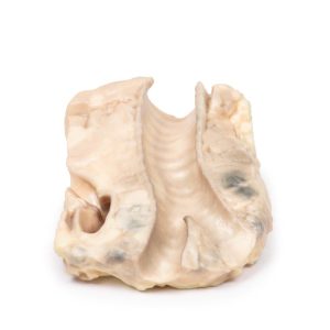 Luchtpijp - Hodgkin Lymfoom, 3D Print
