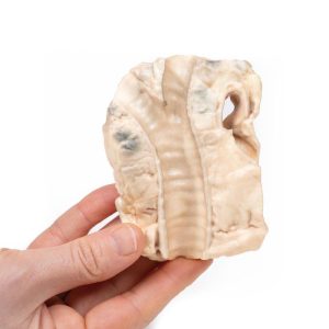 Luchtpijp - Hodgkin Lymfoom, 3D Print