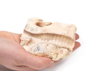 Luchtpijp - Hodgkin Lymfoom, 3D Print