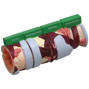 Luchtpijp (Bronchus), 4-dlg model met ziektebeelden
