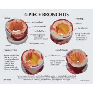 Luchtpijp (Bronchus), 4-dlg model met ziektebeelden