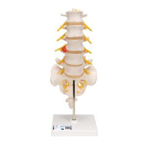 Lumbale Wervelkolom met Hernia