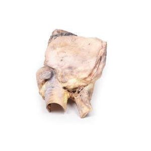 Lymfoom in de Schildklier, 3D Print