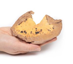 Mesenteriale Metastasen van Cutaan Maligne Melanoom, 3D Print