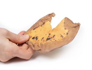 Mesenteriale Metastasen van Cutaan Maligne Melanoom, 3D Print