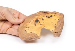 Mesenteriale Metastasen van Cutaan Maligne Melanoom, 3D Print