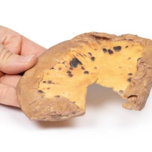 Mesenteriale Metastasen van Cutaan Maligne Melanoom, 3D Print