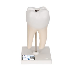 Onderste ware kies met caries 2-delig