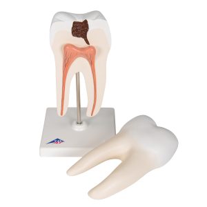 Onderste ware kies met caries 2-delig