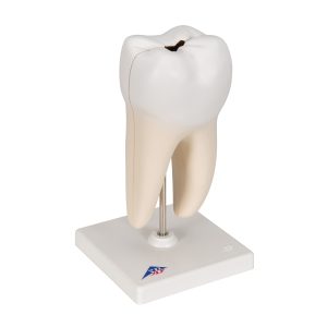 Onderste ware kies met caries 2-delig