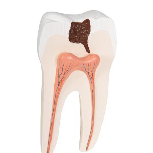 Onderste ware kies met caries 2-delig