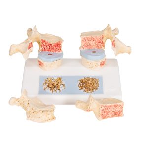 Osteoporose model