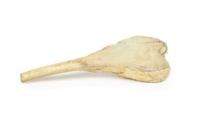 Osteosarcoom in Dijbeen, 3D Print