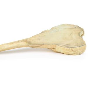 Osteosarcoom in Dijbeen, 3D Print